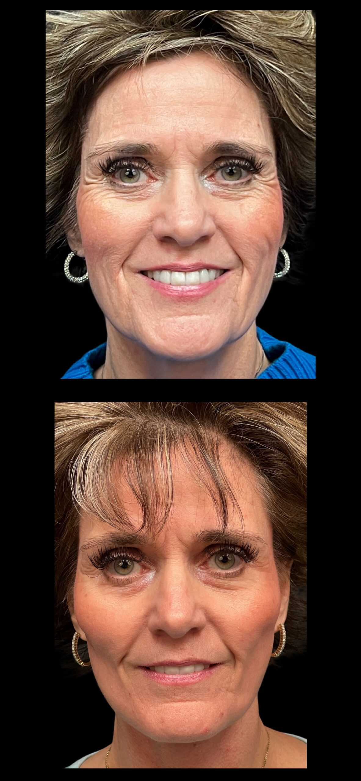 Facelift result at PEAK PLASTIC SURGERY