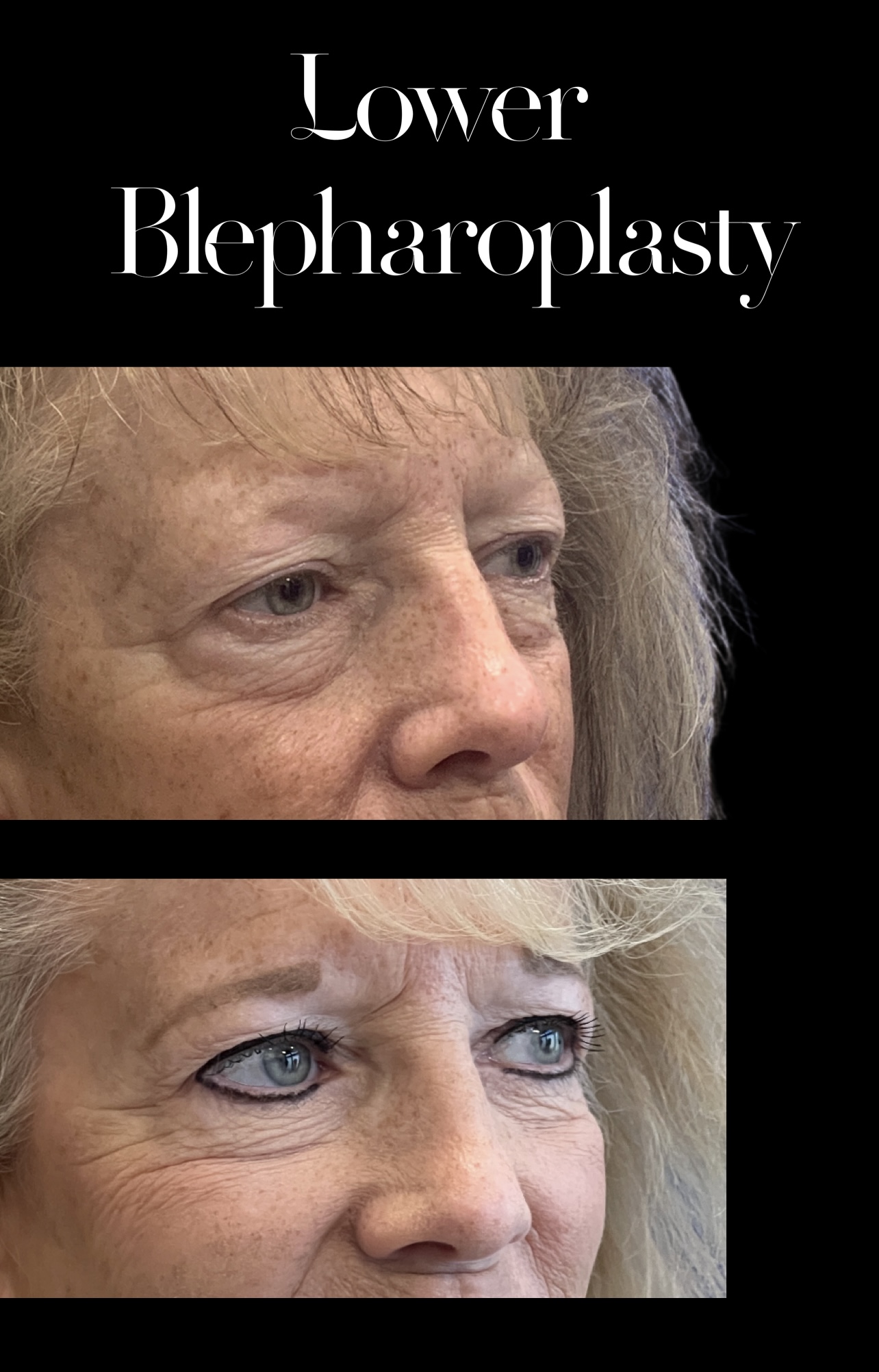 Blepharoplasty result at PEAK PLASTIC SURGERY