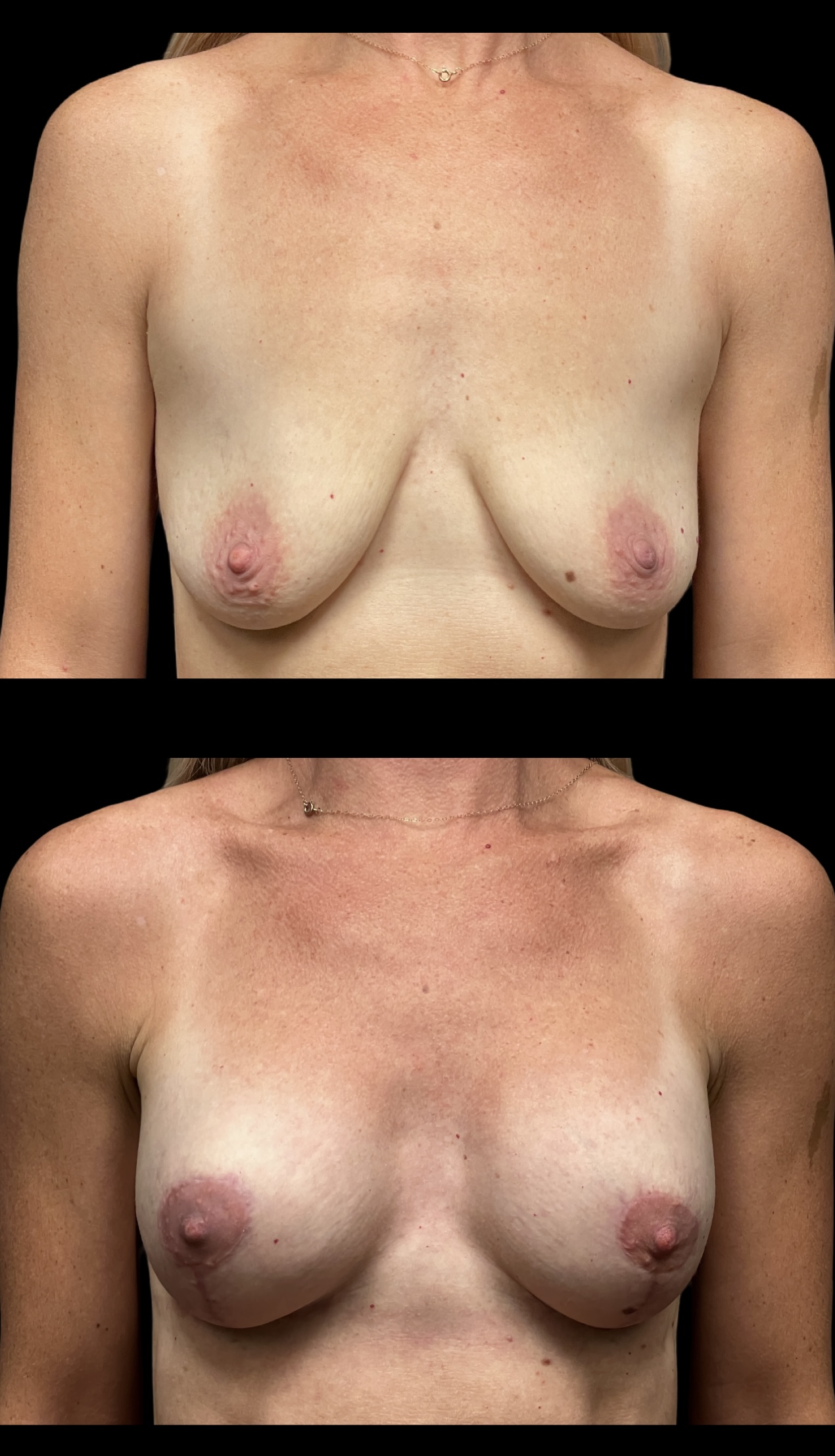 Breast Lift result at PEAK PLASTIC SURGERY
