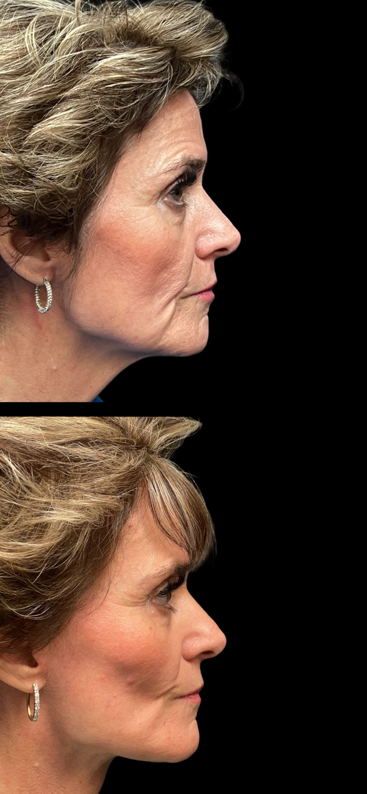 Facelift result at PEAK PLASTIC SURGERY