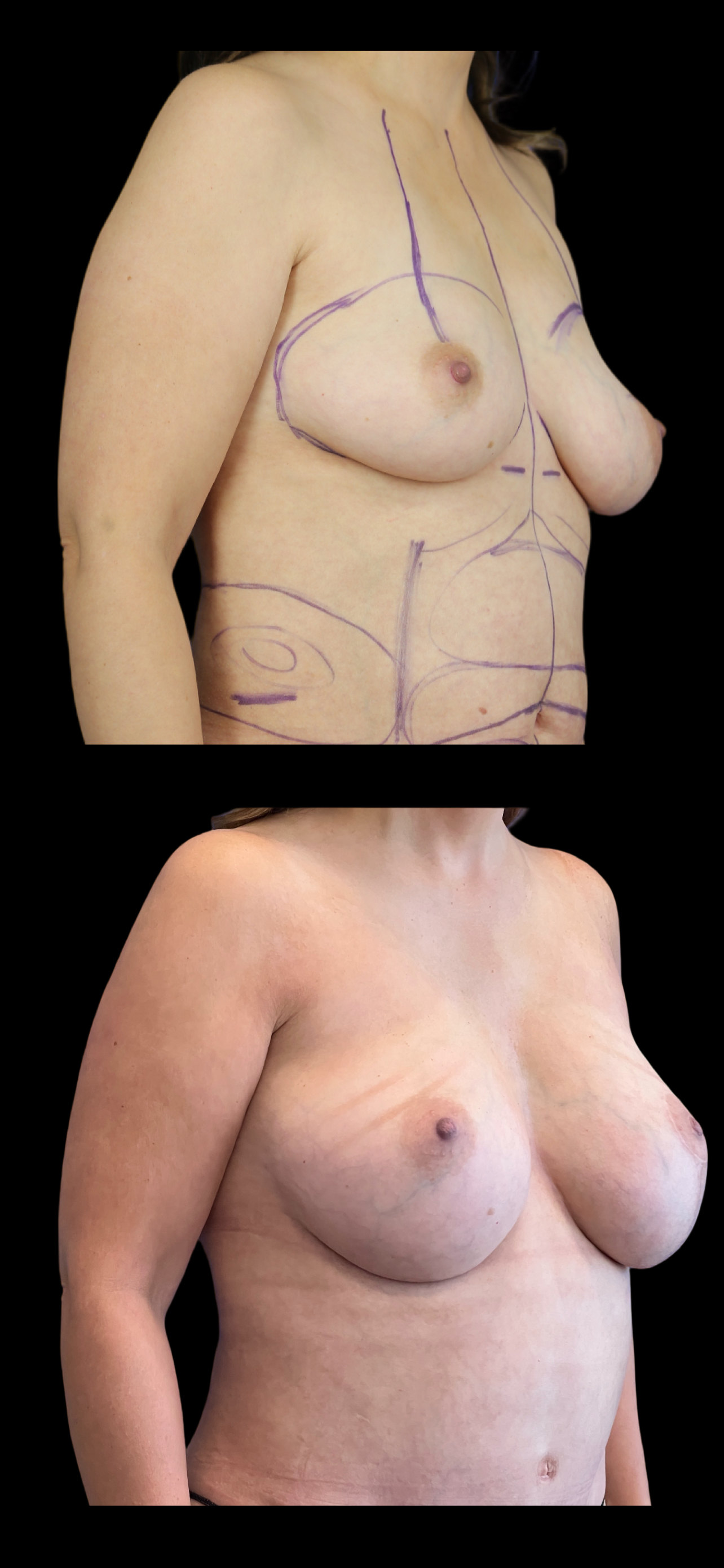 Breast Lift result at PEAK PLASTIC SURGERY
