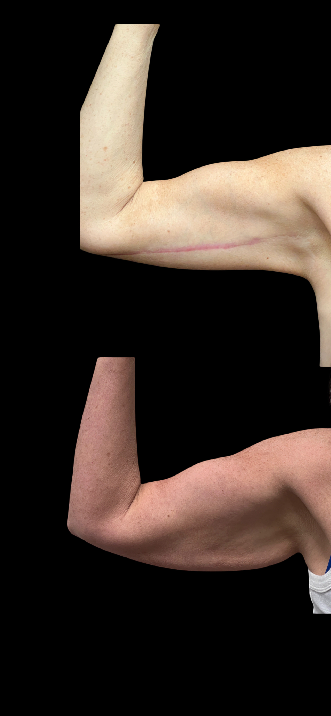 Arm Lift result at PEAK PLASTIC SURGERY