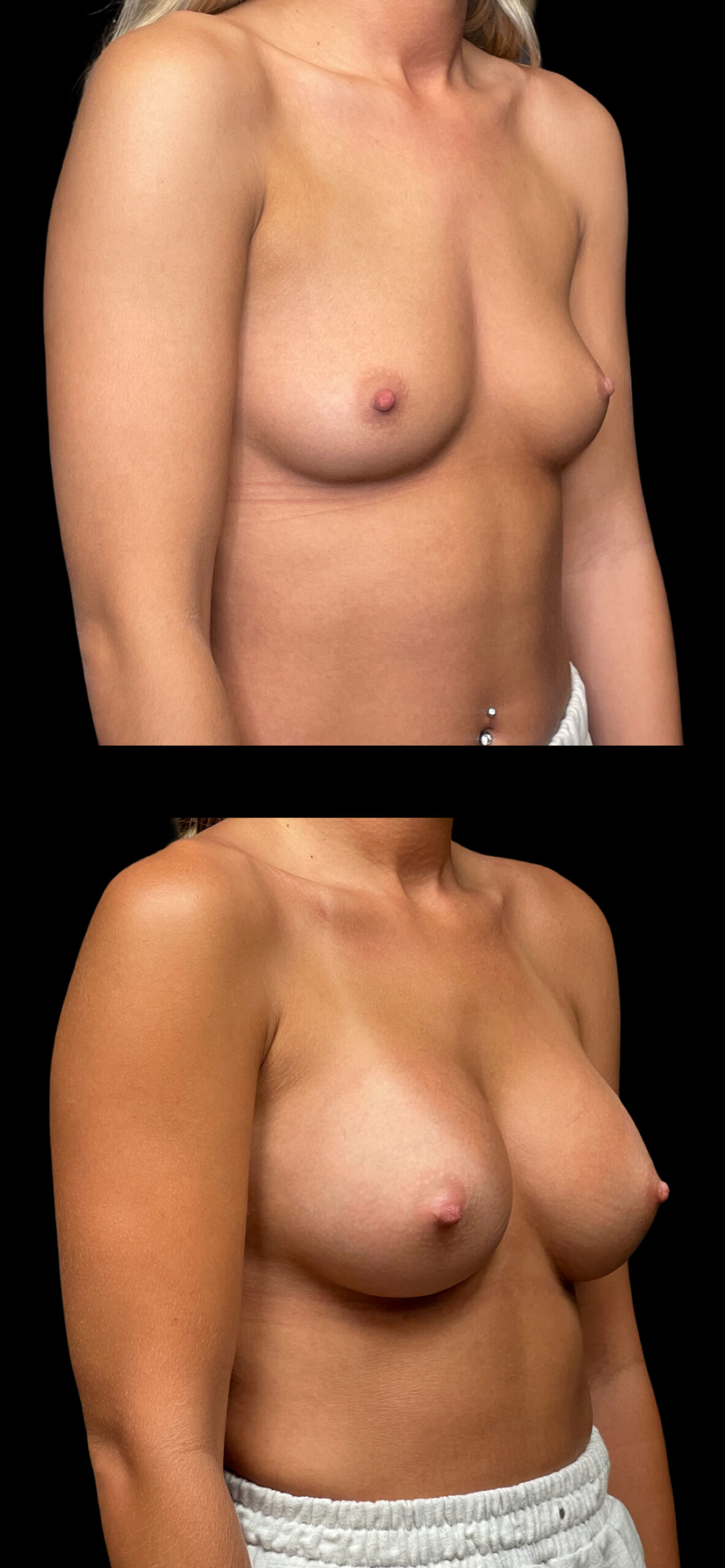 Breast Augmentation result at PEAK PLASTIC SURGERY