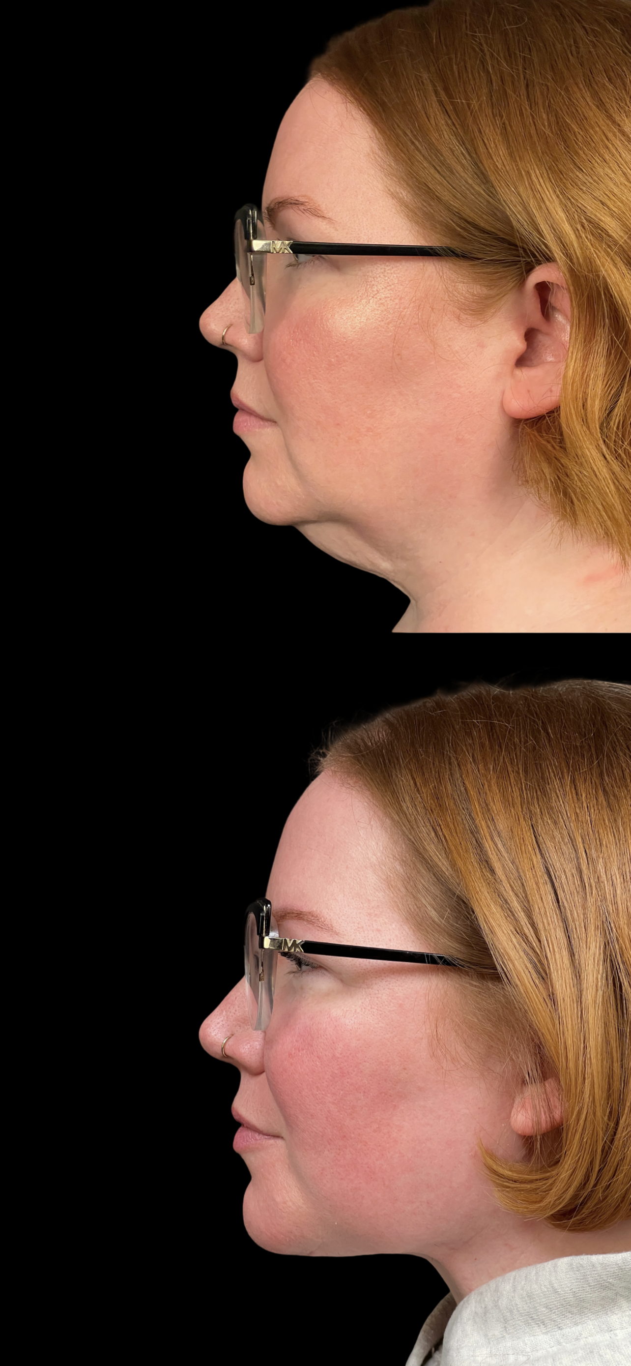 Neck Lift result at PEAK PLASTIC SURGERY
