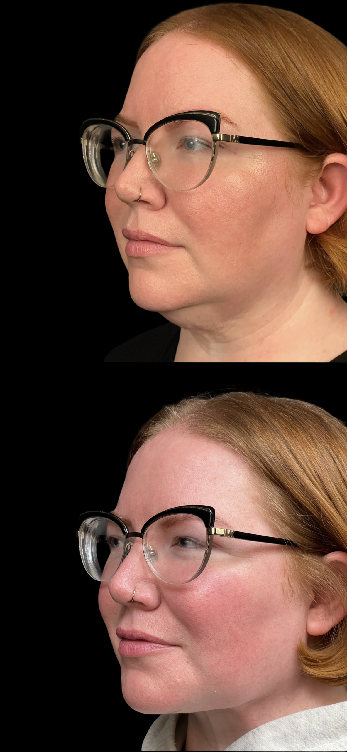 Neck Lift result at PEAK PLASTIC SURGERY