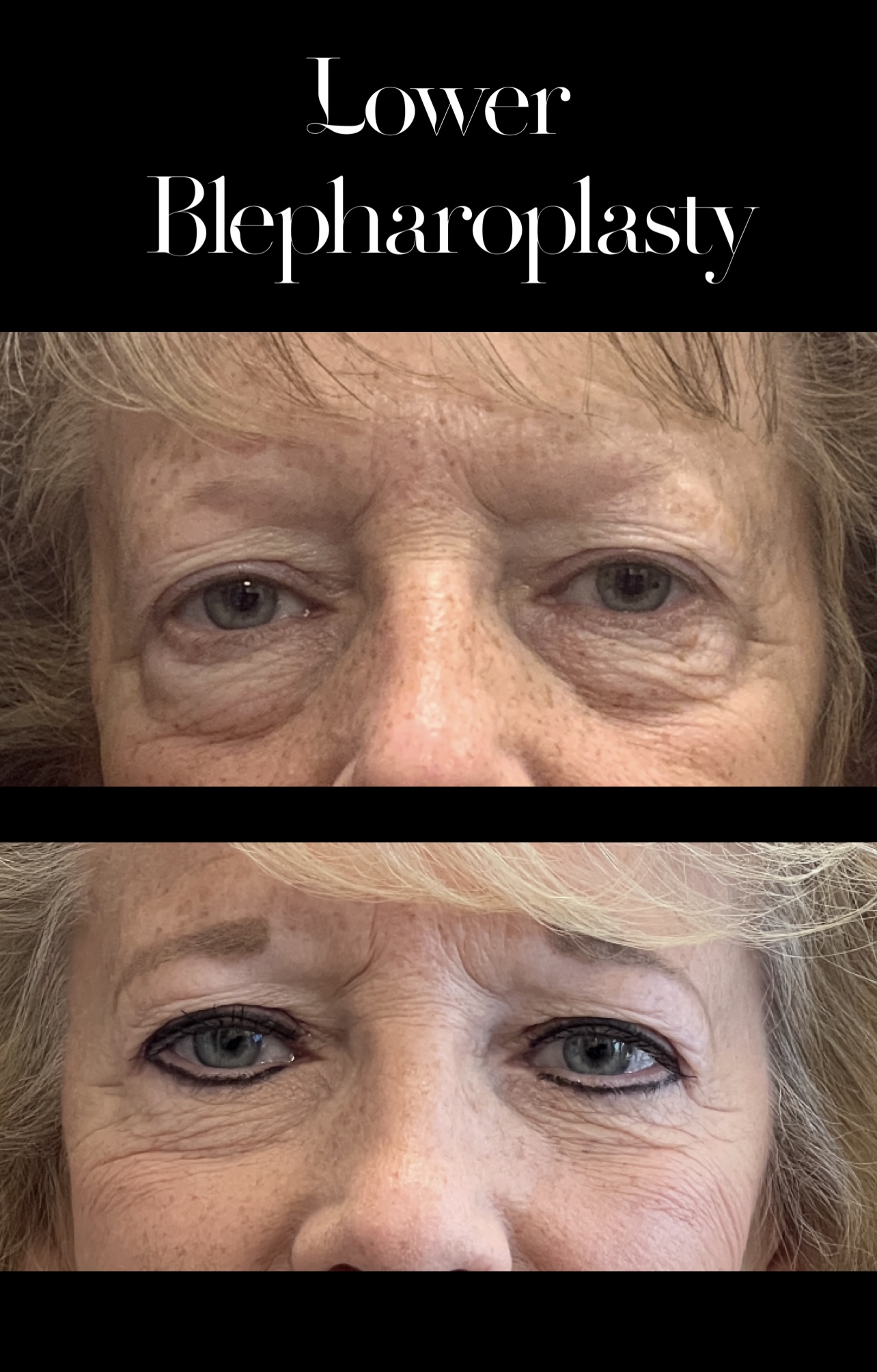 Blepharoplasty result at PEAK PLASTIC SURGERY