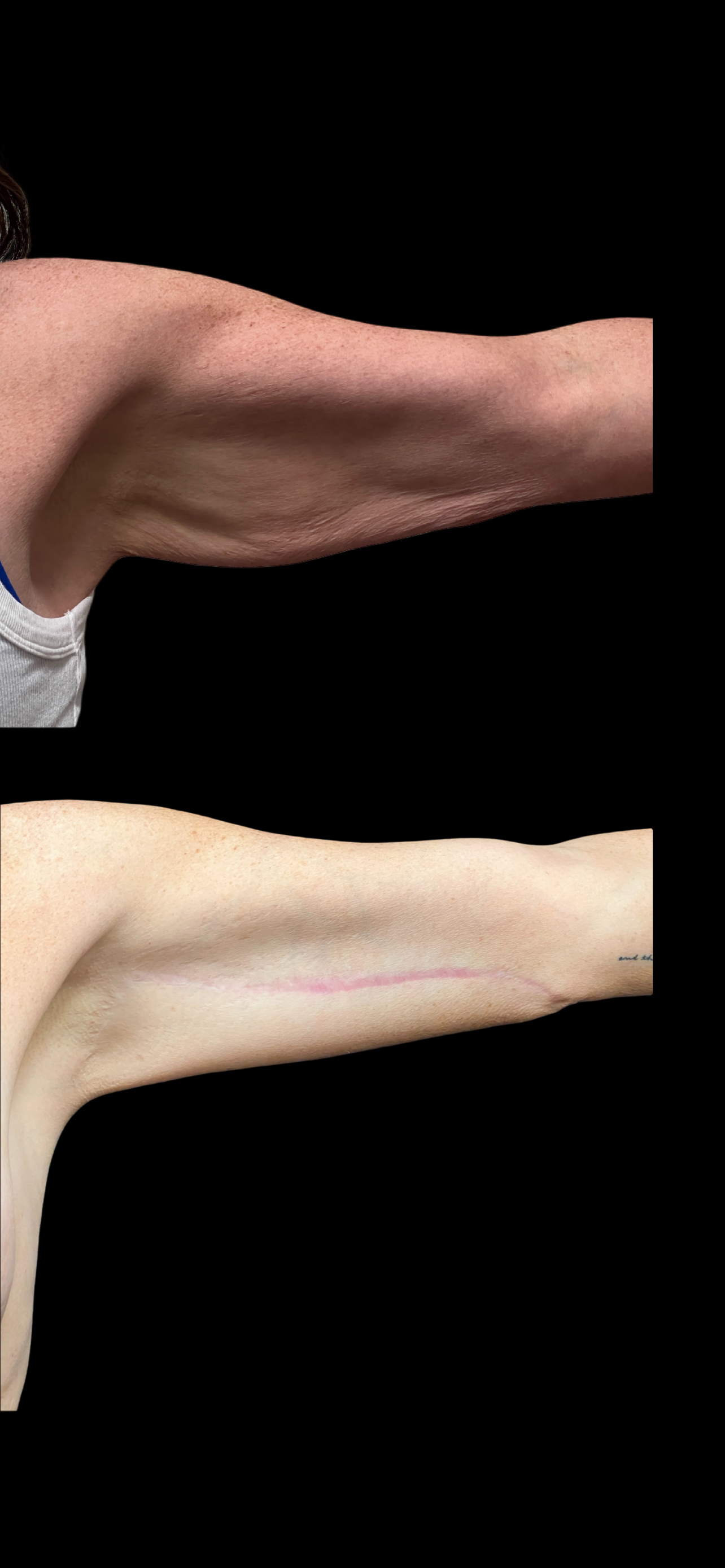Arm Lift result at PEAK PLASTIC SURGERY