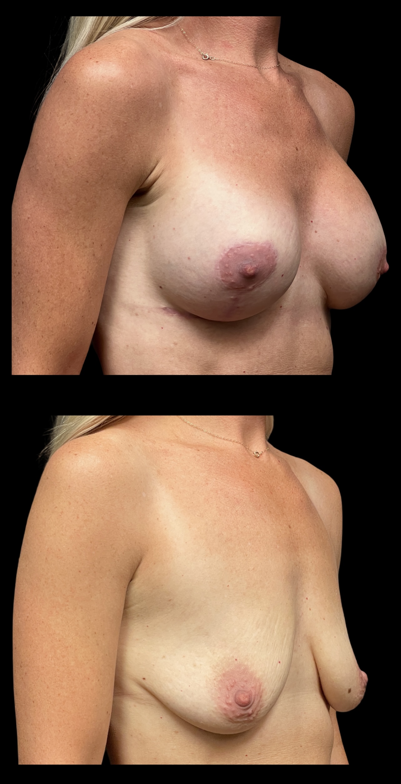 Breast Lift result at PEAK PLASTIC SURGERY