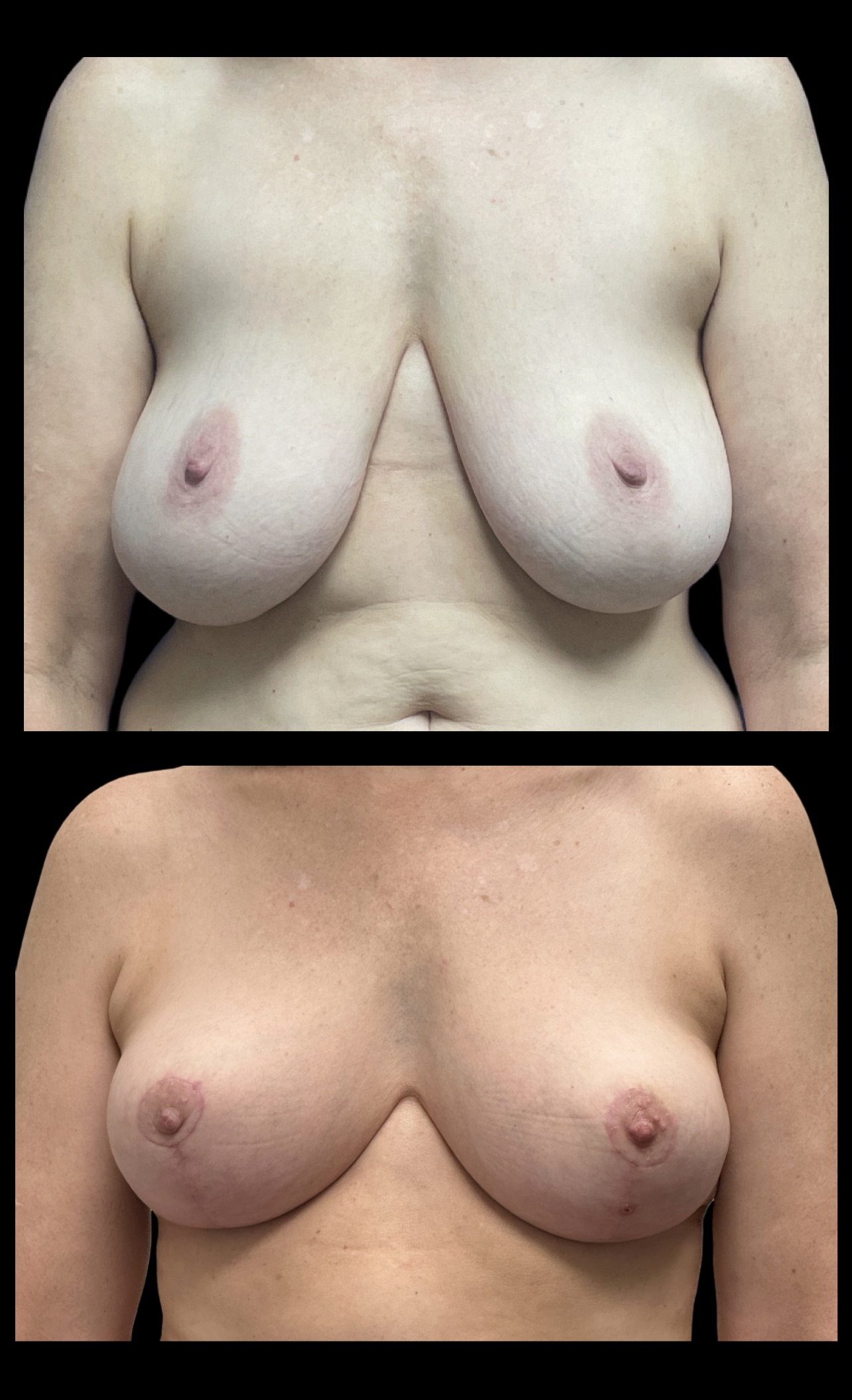 Breast Reduction result at PEAK PLASTIC SURGERY