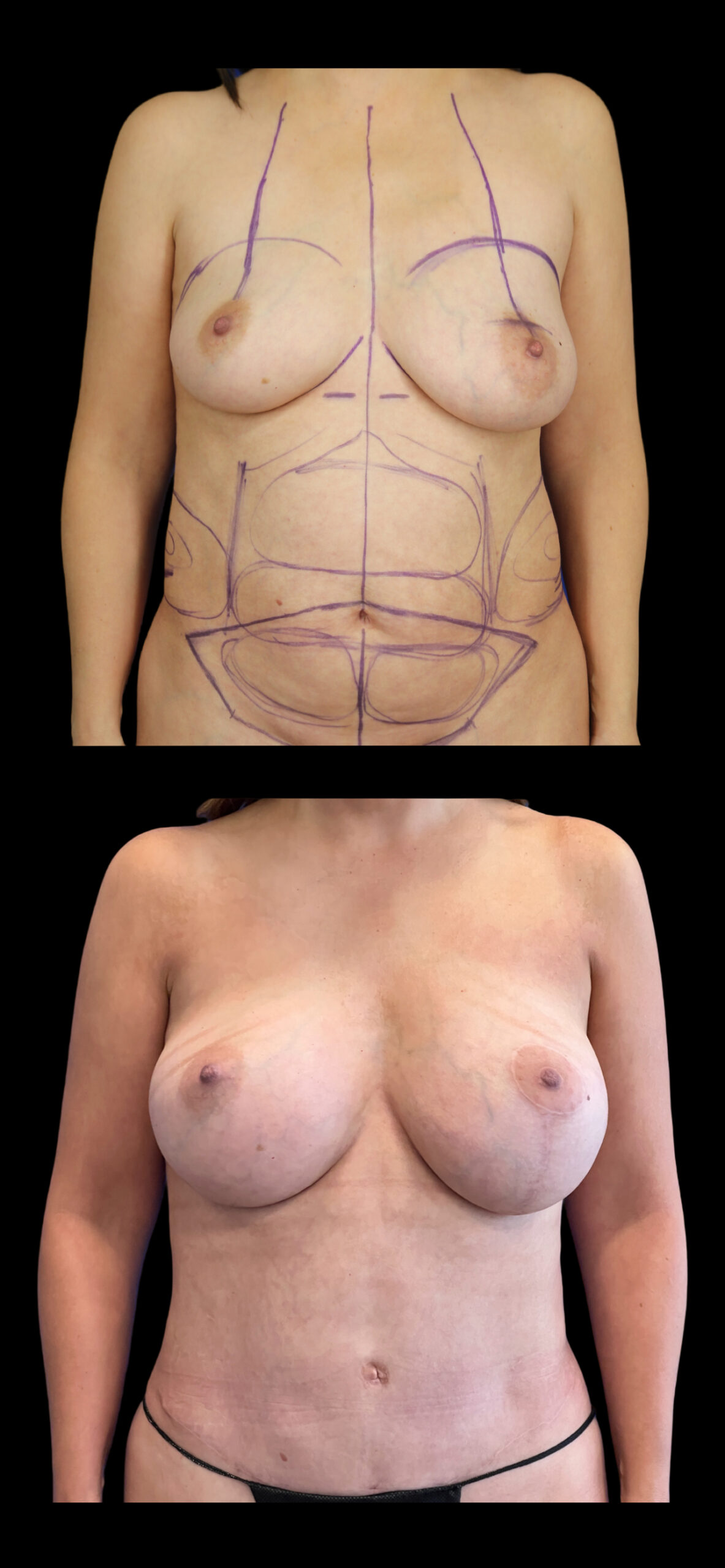 Breast Lift result at PEAK PLASTIC SURGERY