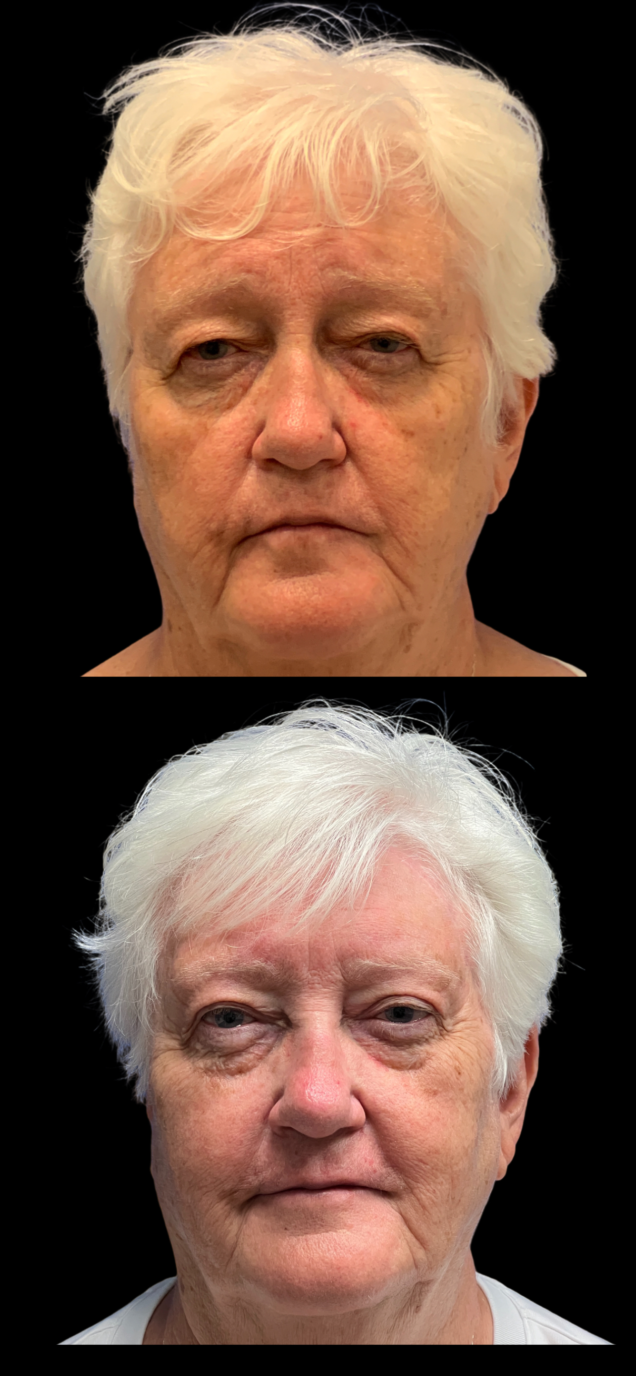 Brow Lift result at PEAK PLASTIC SURGERY