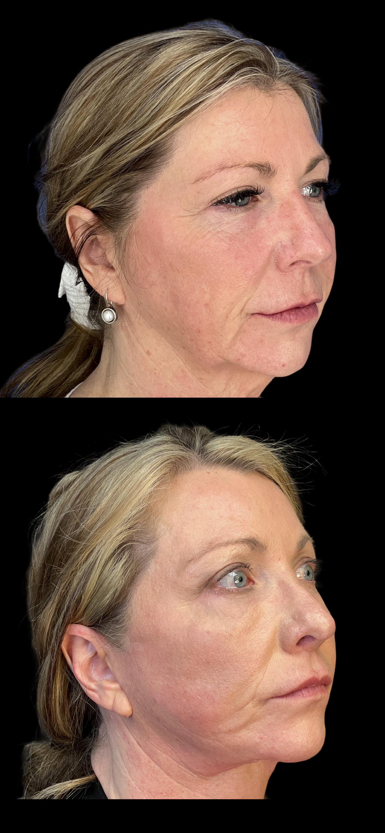 Facelift result at PEAK PLASTIC SURGERY