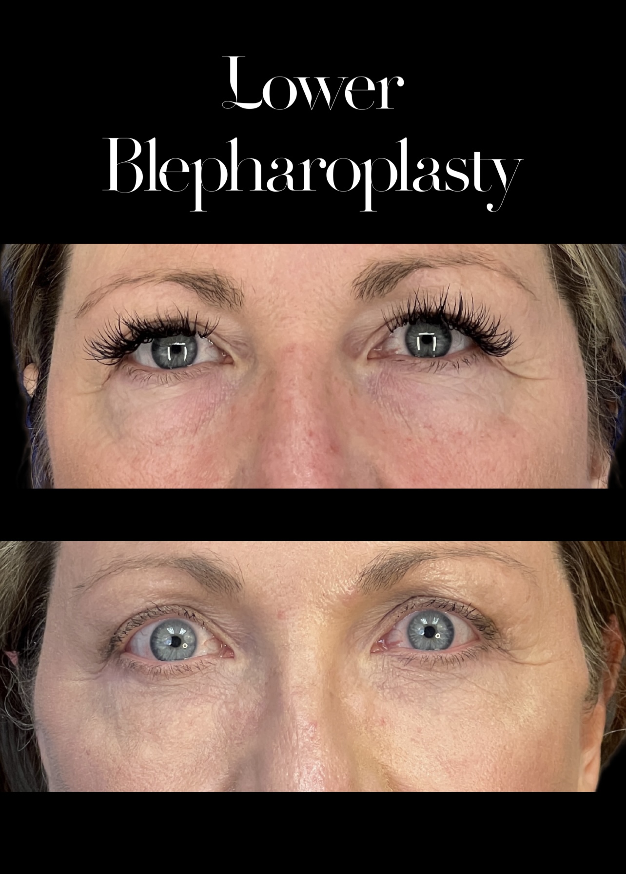 Blepharoplasty result at PEAK PLASTIC SURGERY