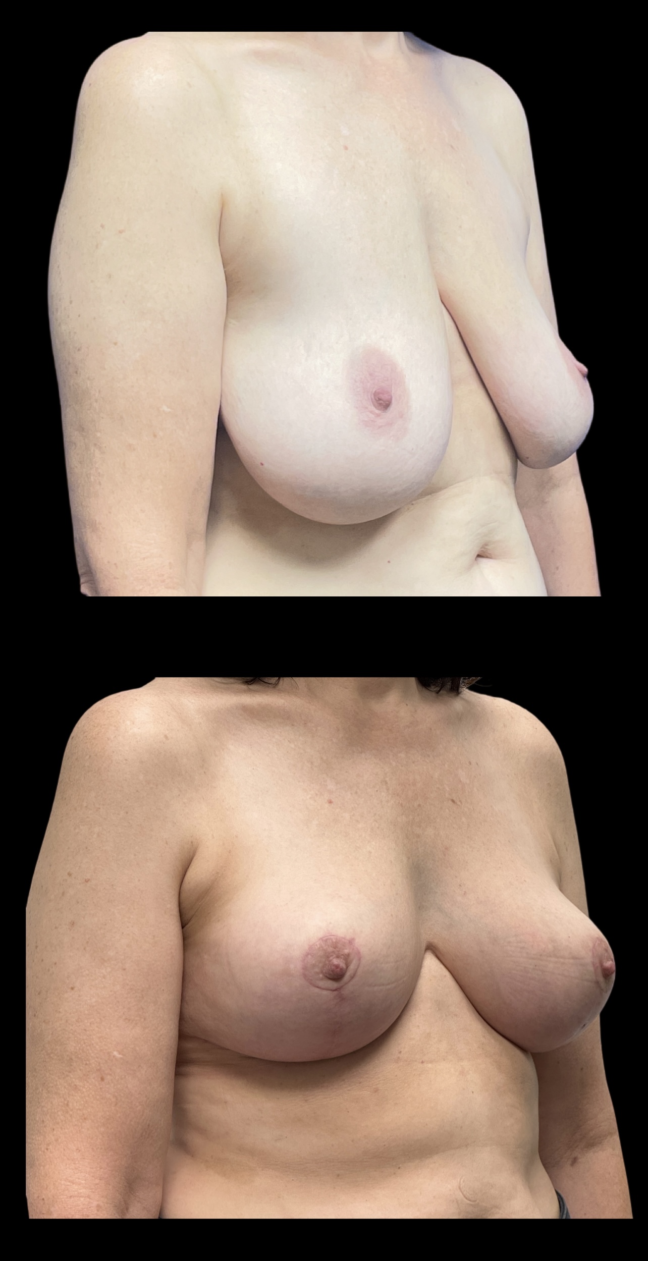 Breast Reduction result at PEAK PLASTIC SURGERY