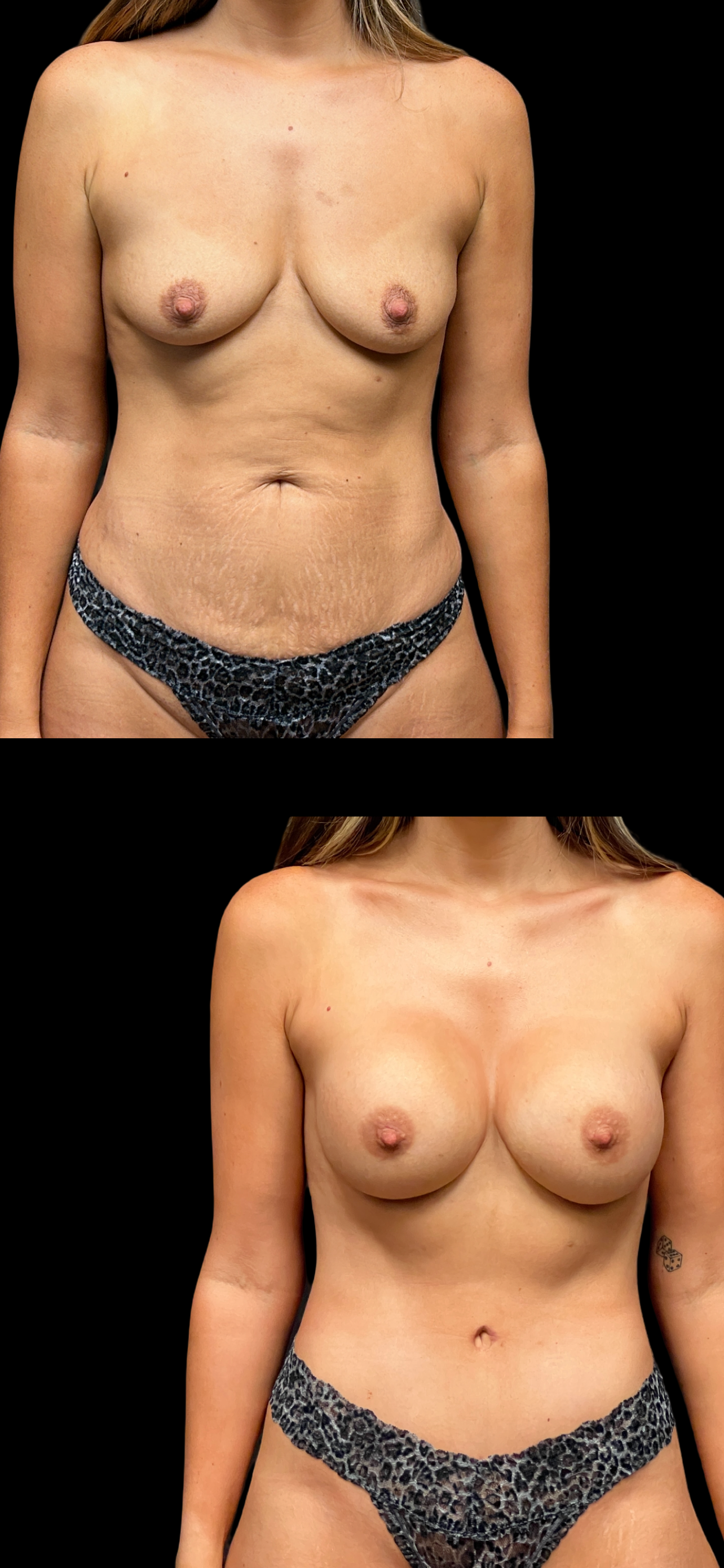 Mommy Makeover result at PEAK PLASTIC SURGERY