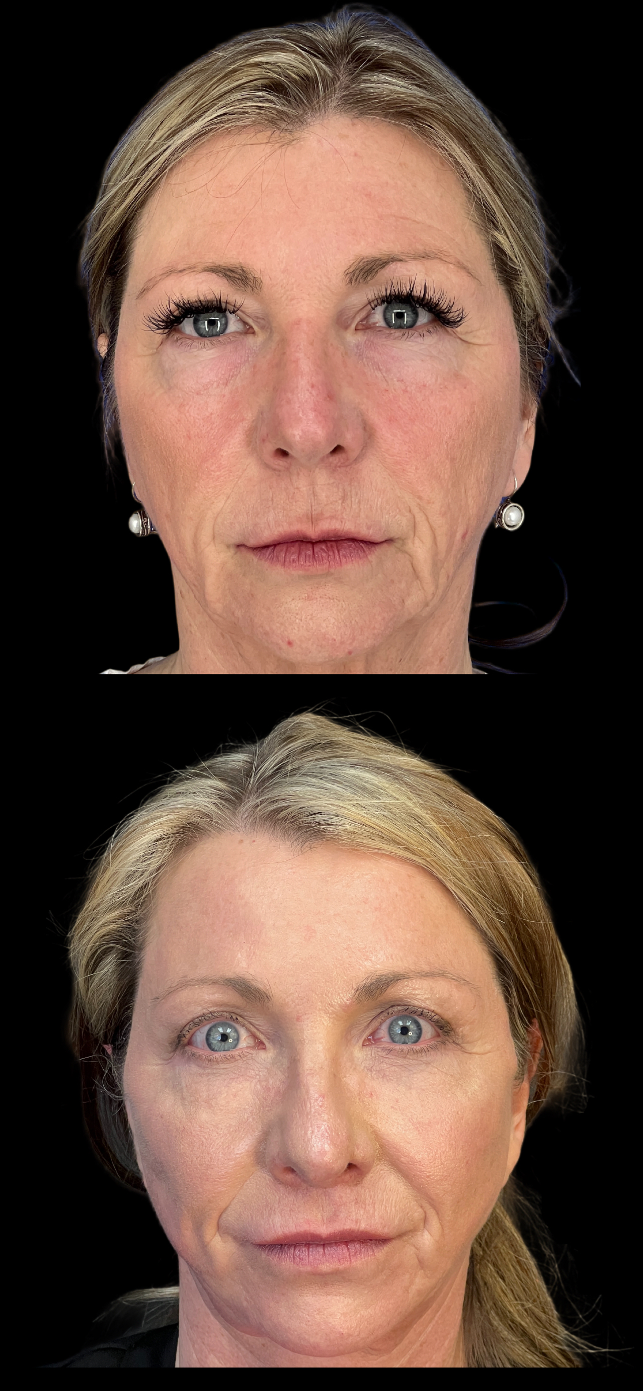 Facelift result at PEAK PLASTIC SURGERY