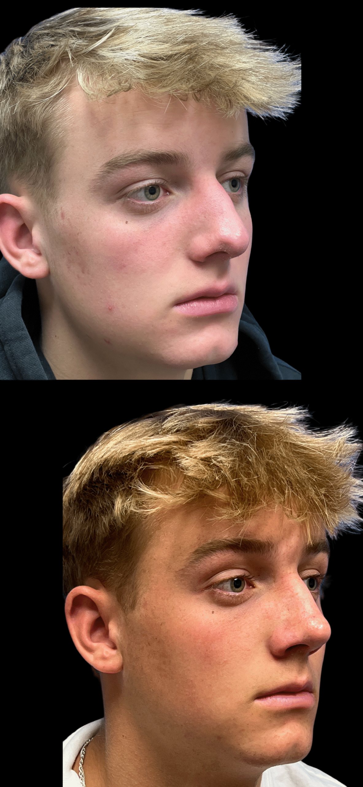 Rhinoplasty result at PEAK PLASTIC SURGERY