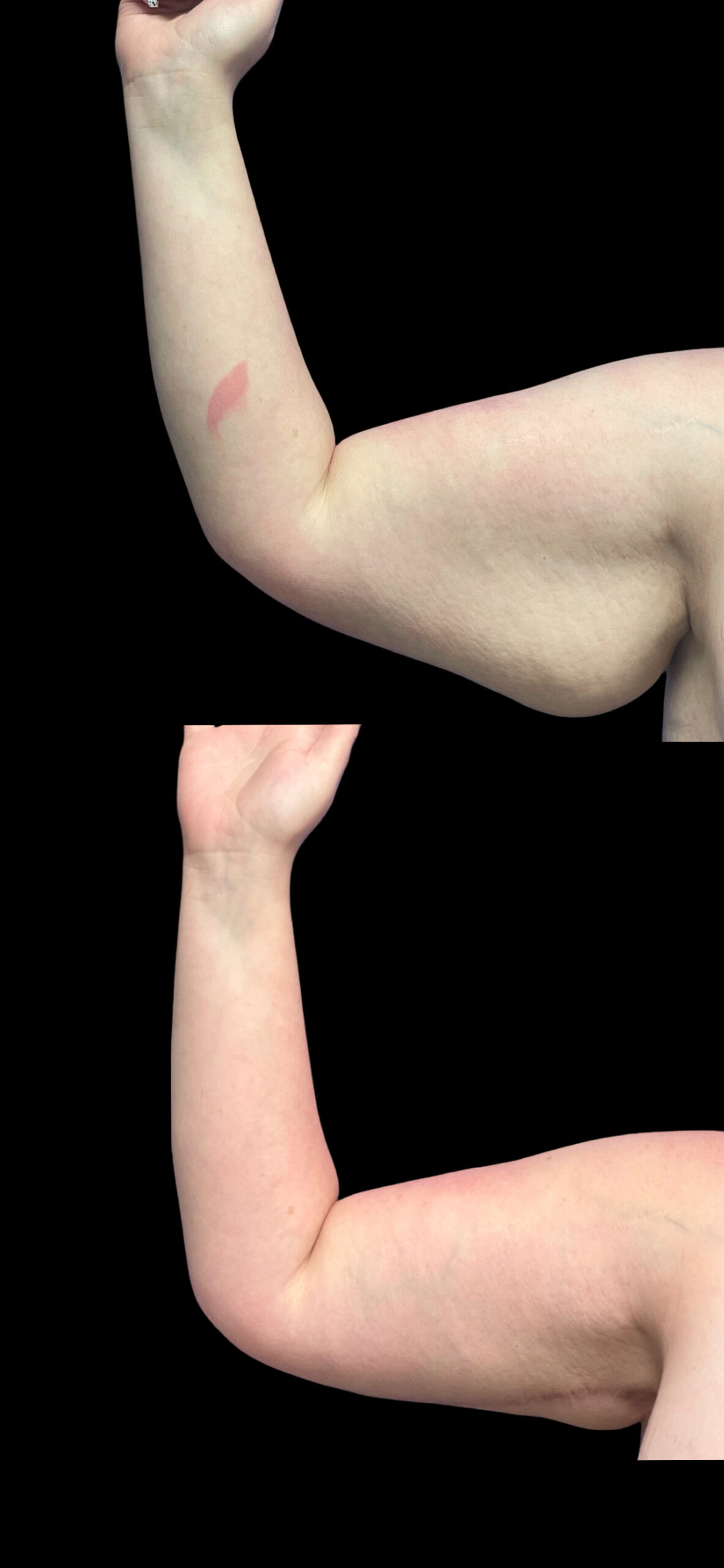 Arm Lift result at PEAK PLASTIC SURGERY