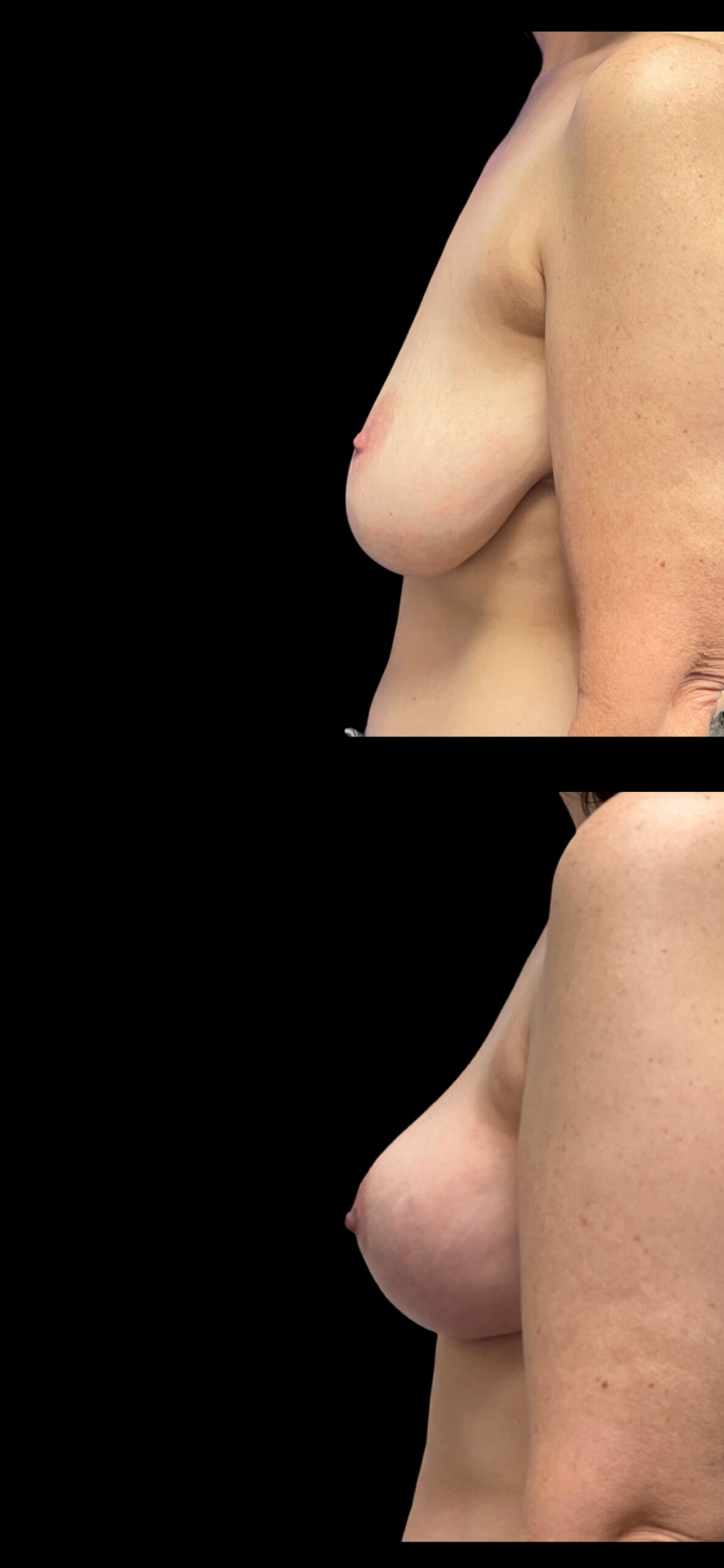 Breast Reduction result at PEAK PLASTIC SURGERY