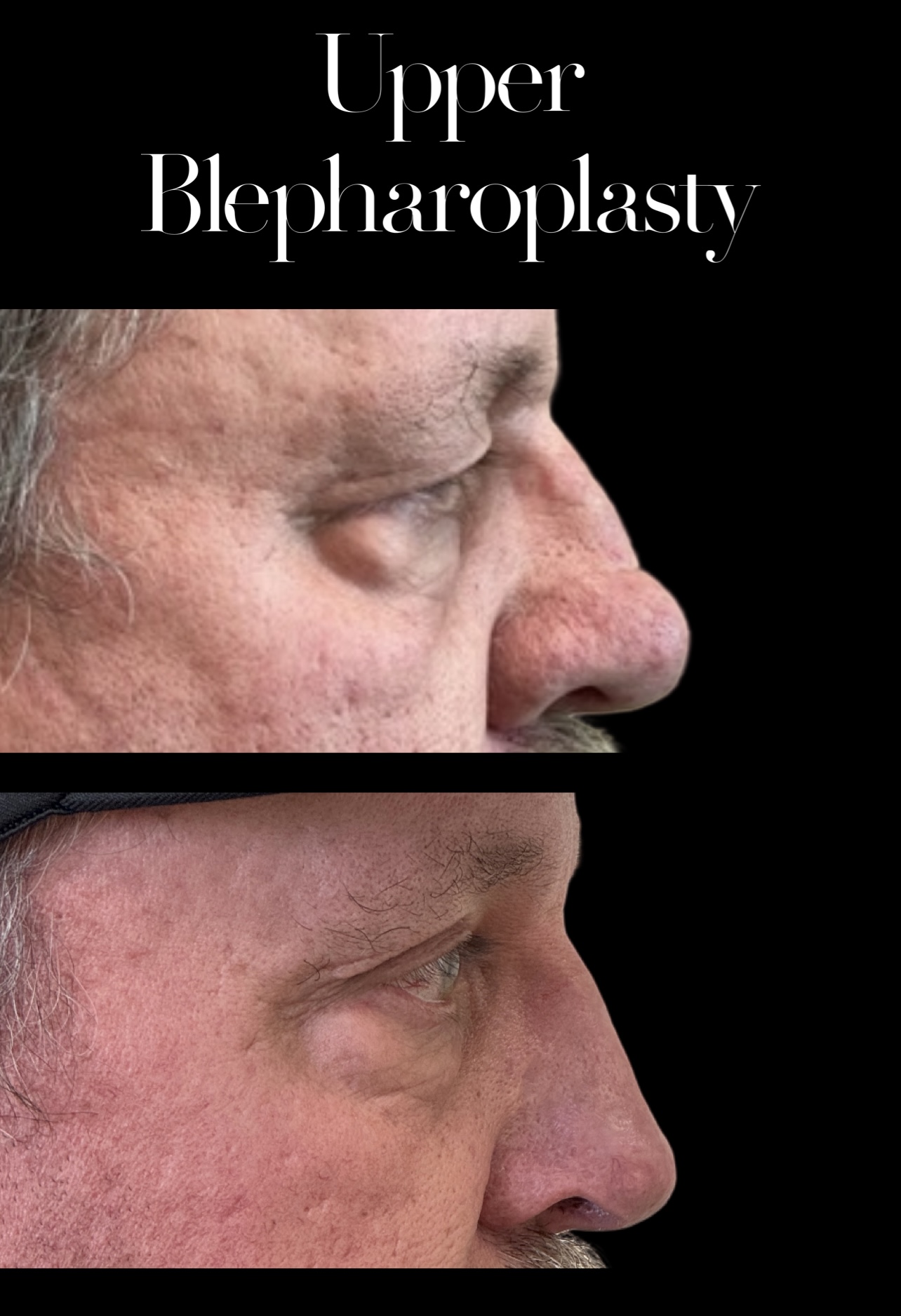 Blepharoplasty result at PEAK PLASTIC SURGERY