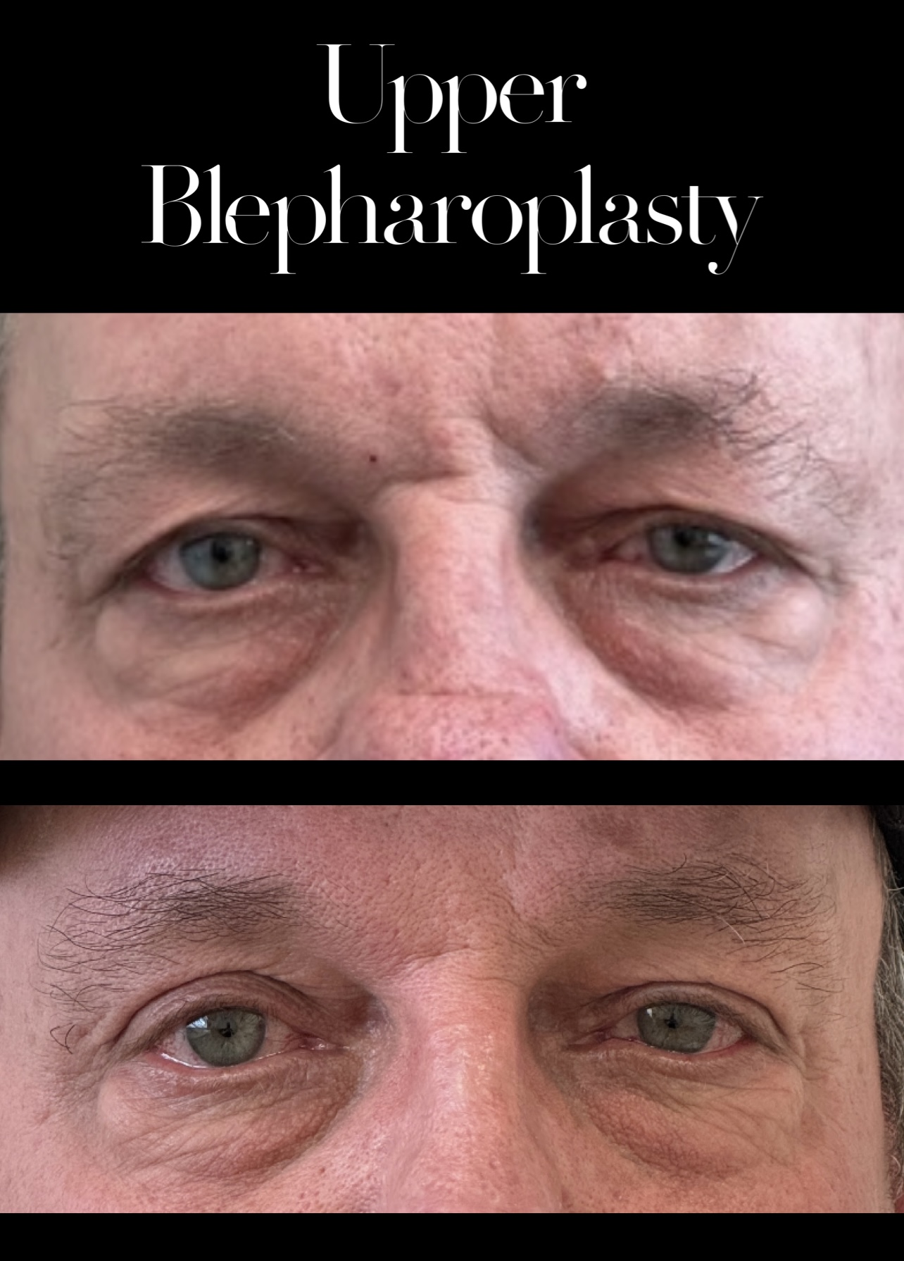 Blepharoplasty result at PEAK PLASTIC SURGERY