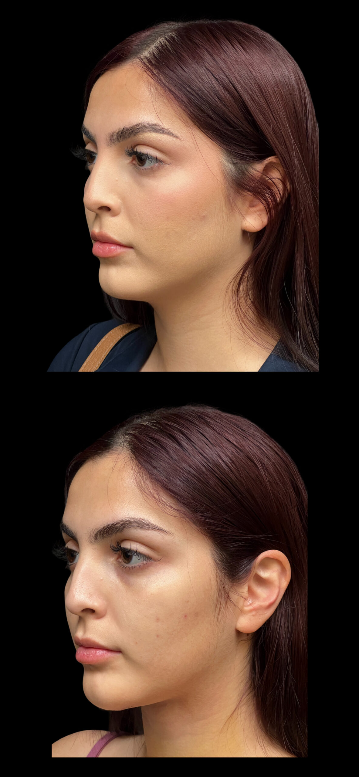 Neck Lift result at PEAK PLASTIC SURGERY