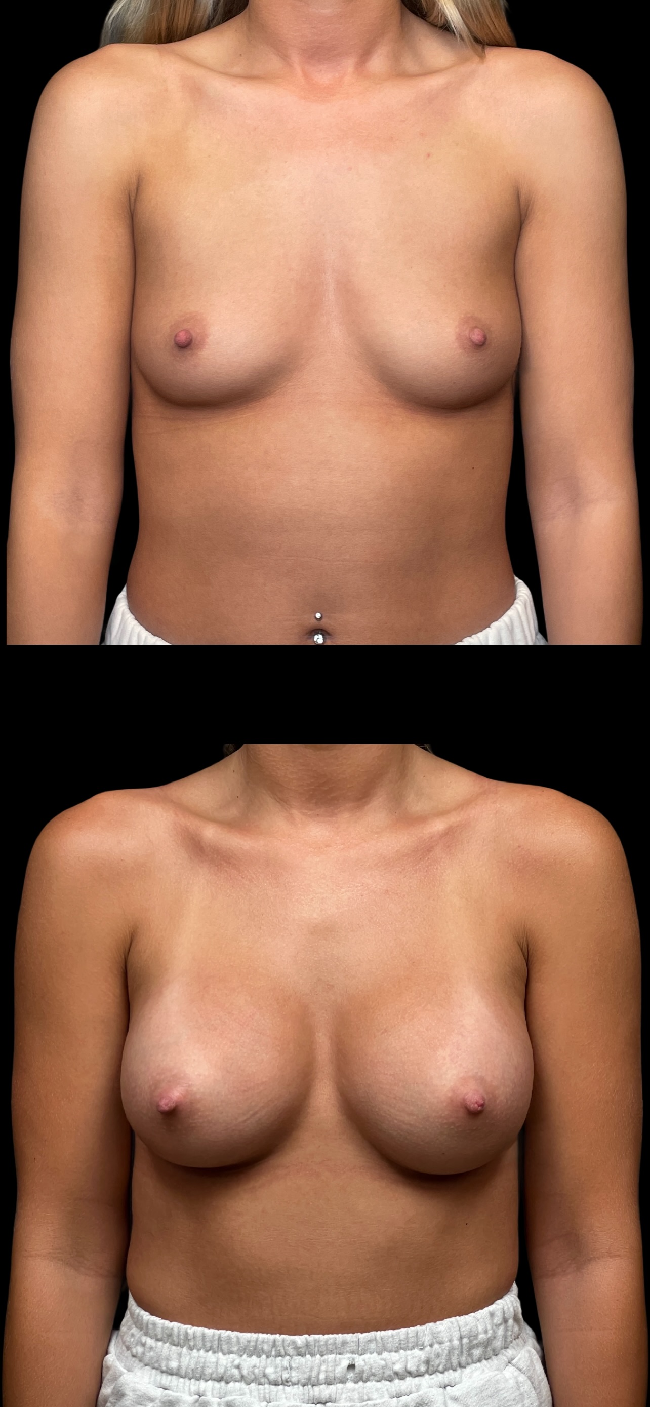 Breast Augmentation result at PEAK PLASTIC SURGERY