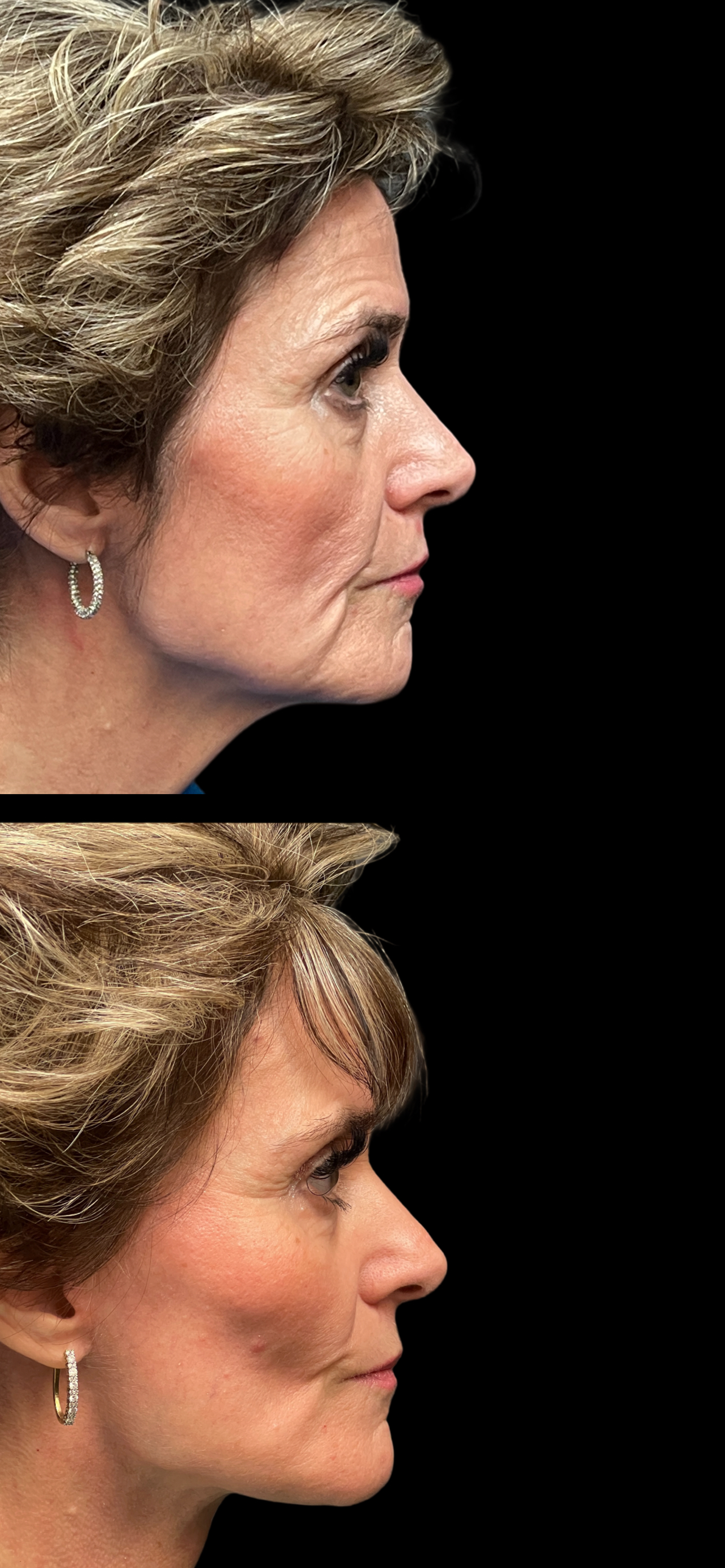 Facelift result at PEAK PLASTIC SURGERY