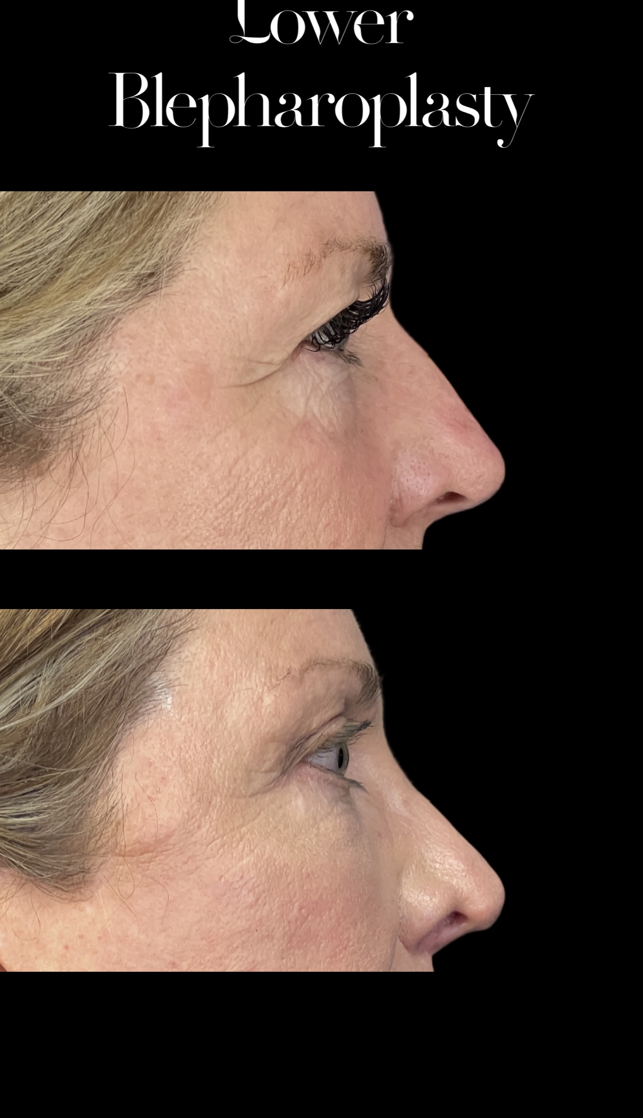 Blepharoplasty result at PEAK PLASTIC SURGERY