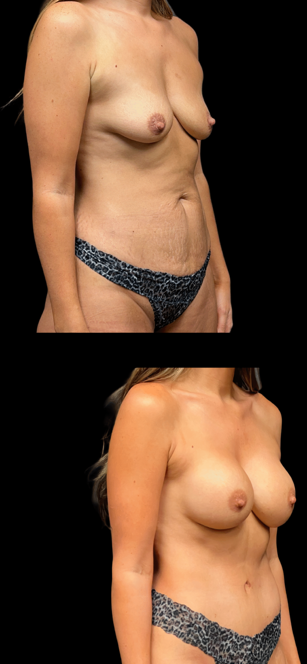 Mommy Makeover result at PEAK PLASTIC SURGERY