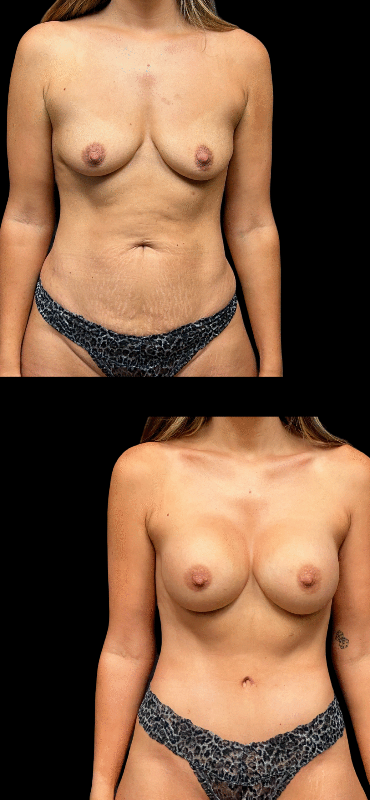 Mommy Makeover result at PEAK PLASTIC SURGERY