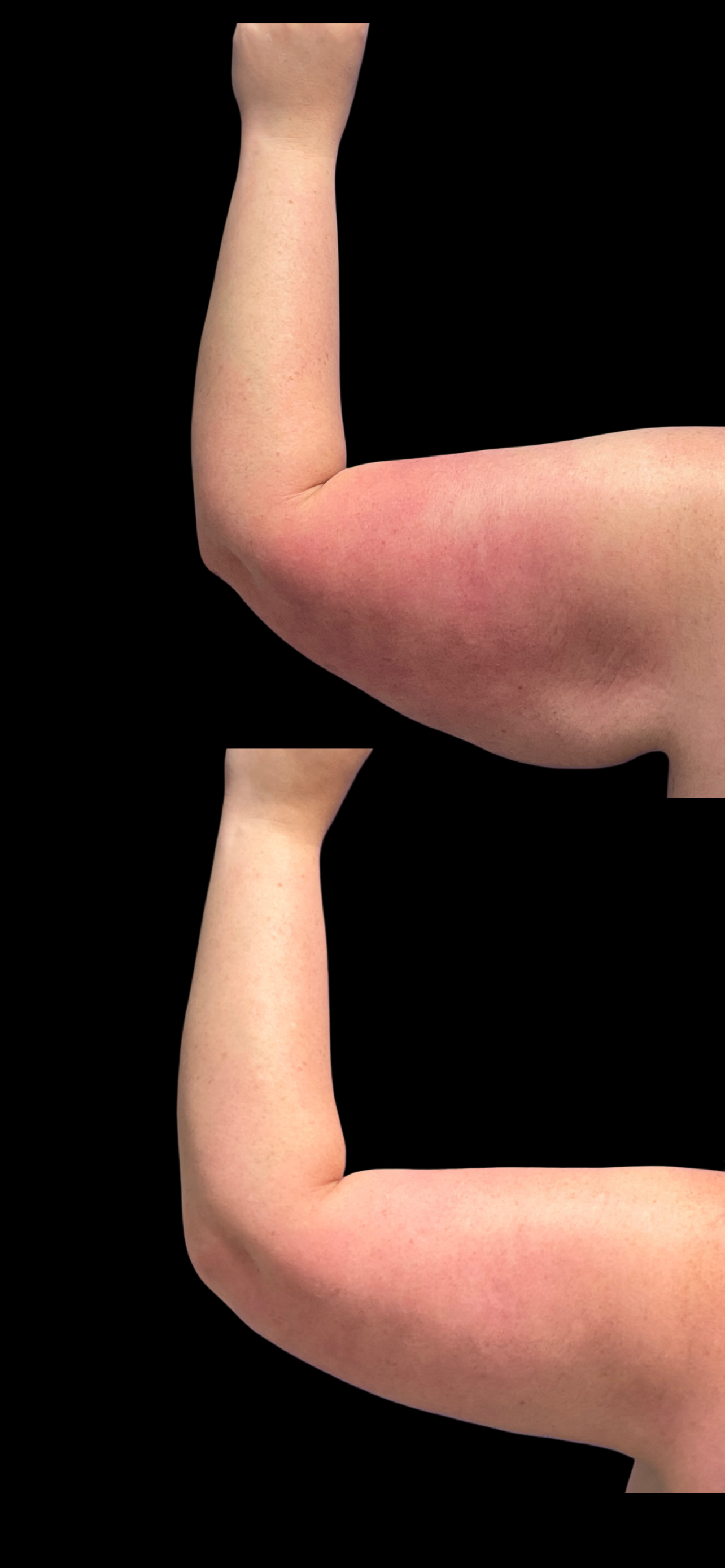 Arm Lift result at PEAK PLASTIC SURGERY