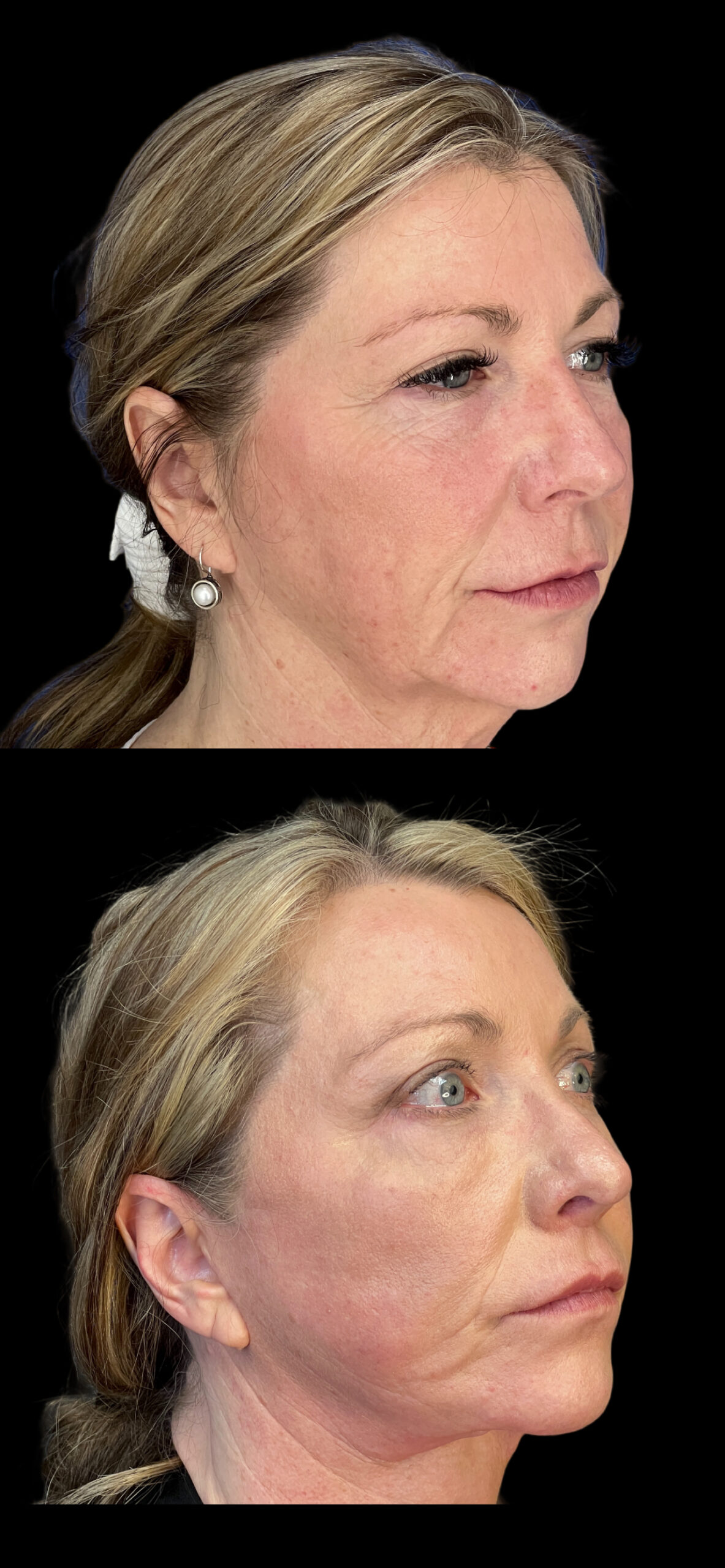 Facelift result at PEAK PLASTIC SURGERY