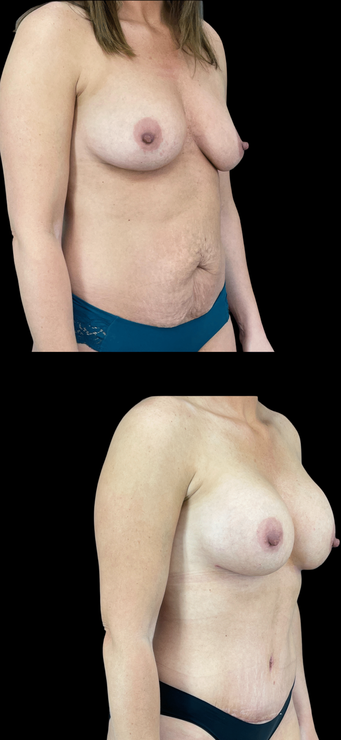 Mommy Makeover result at PEAK PLASTIC SURGERY