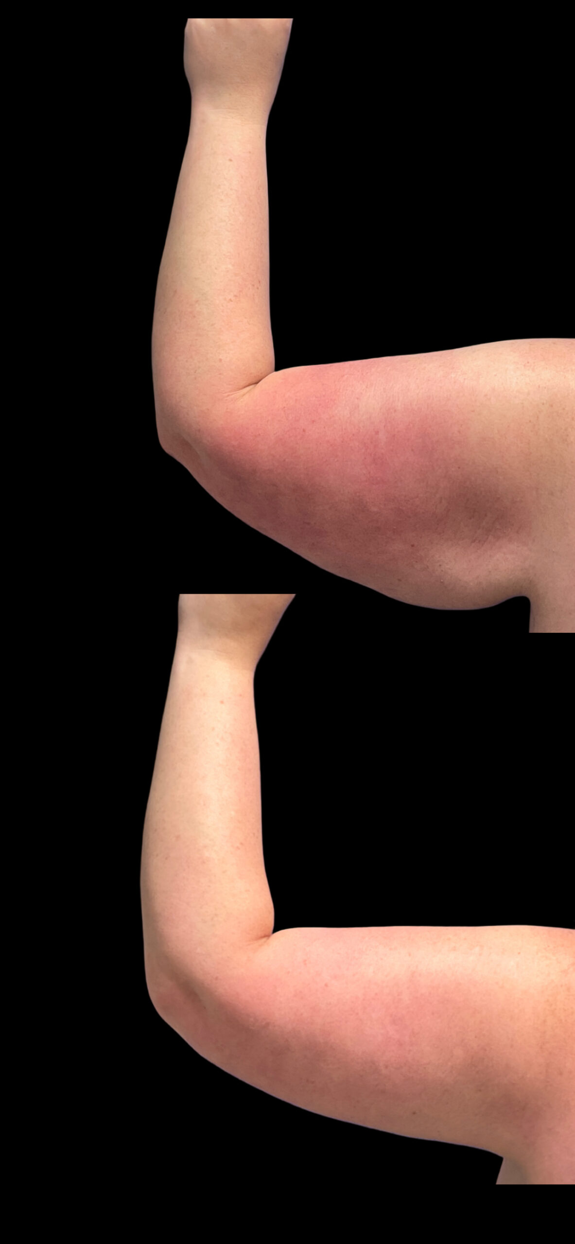Arm Lift result at PEAK PLASTIC SURGERY