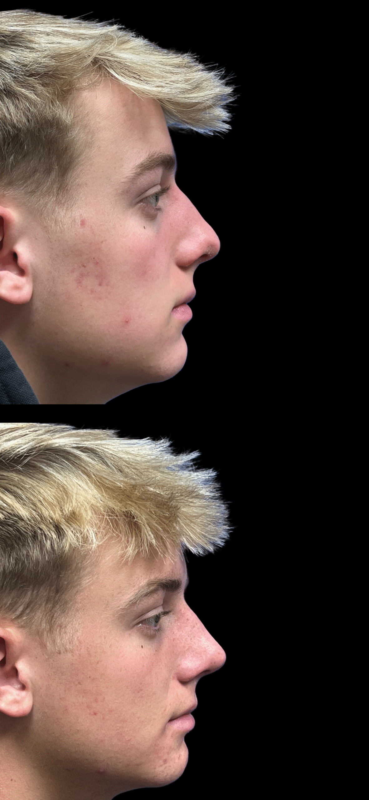 Rhinoplasty result at PEAK PLASTIC SURGERY