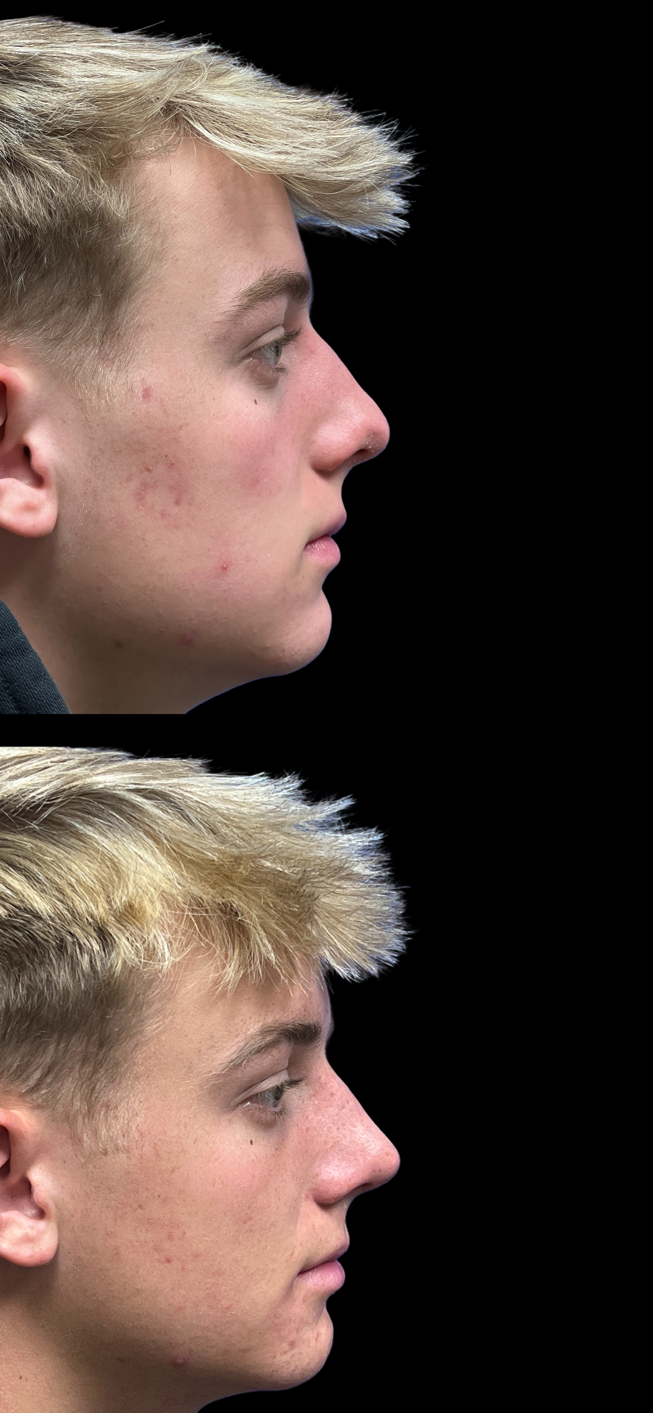 Rhinoplasty result at PEAK PLASTIC SURGERY