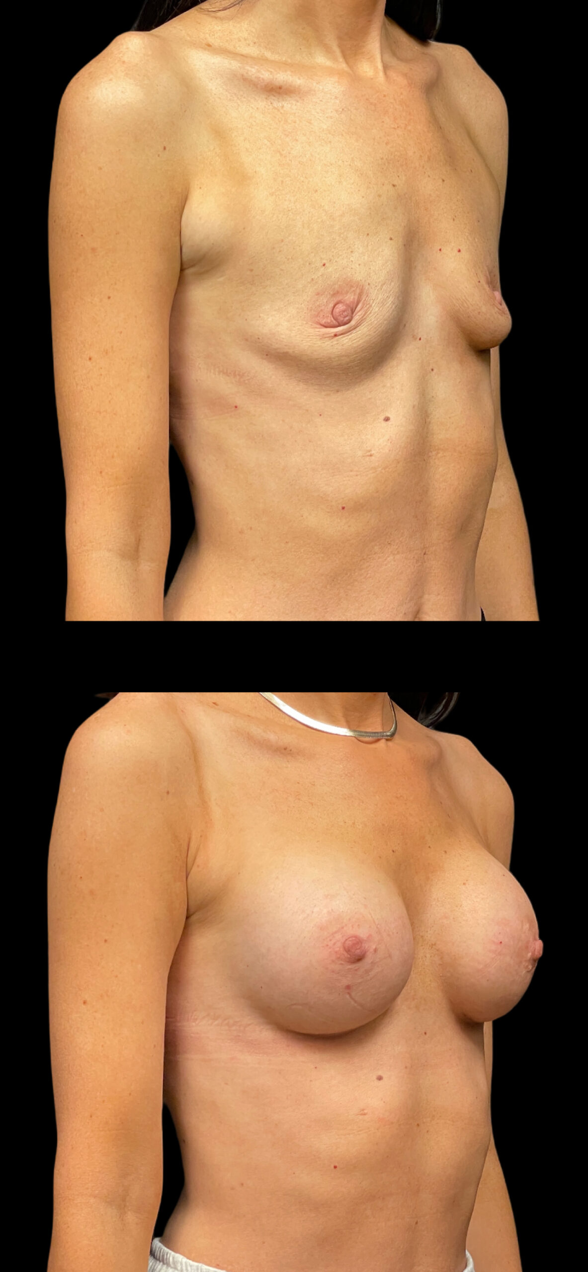 Breast Augmentation result at PEAK PLASTIC SURGERY