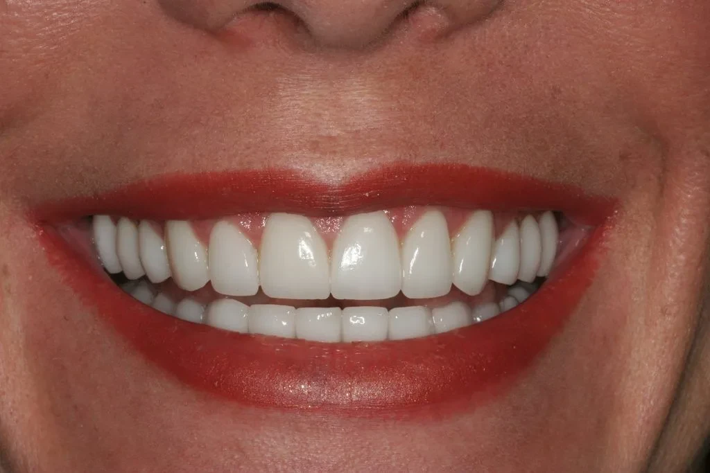 A result from Lasting Smiles Dental Implant Center