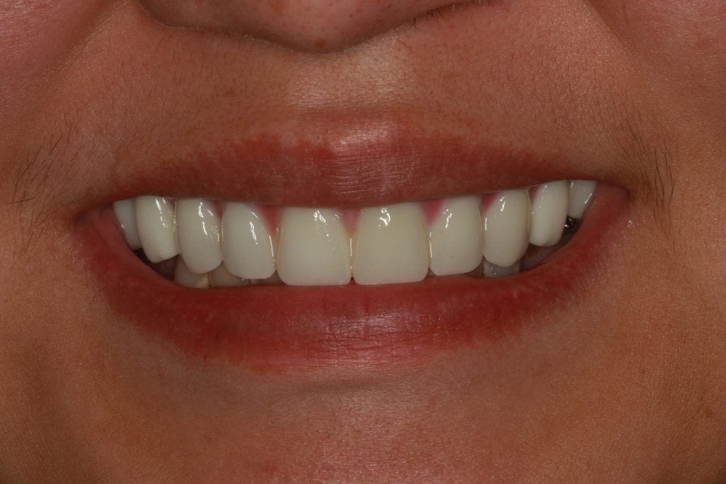 A result from Lasting Smiles Dental Implant Center