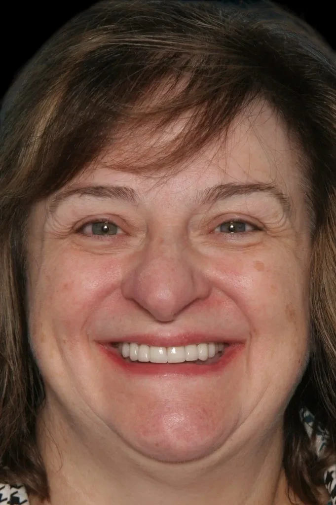 A result from Lasting Smiles Dental Implant Center