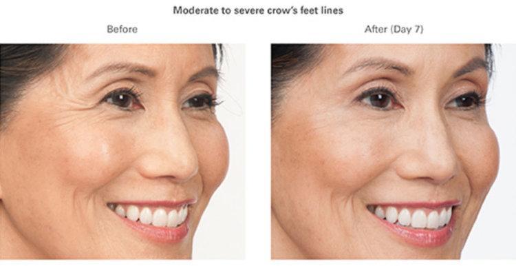 A result from Best Impression Med Spa