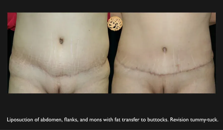 A result from Nazarian Plastic Surgery