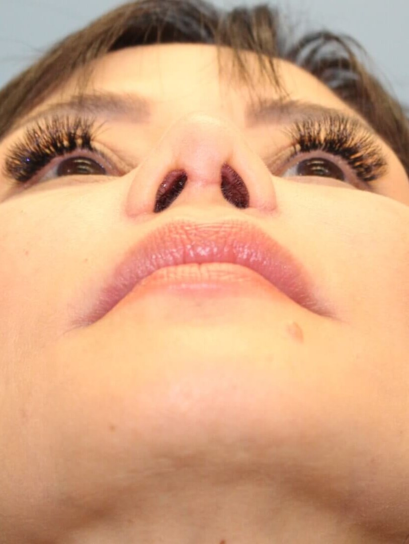 Rhinoplasty result at Platinum Plastic Surgery