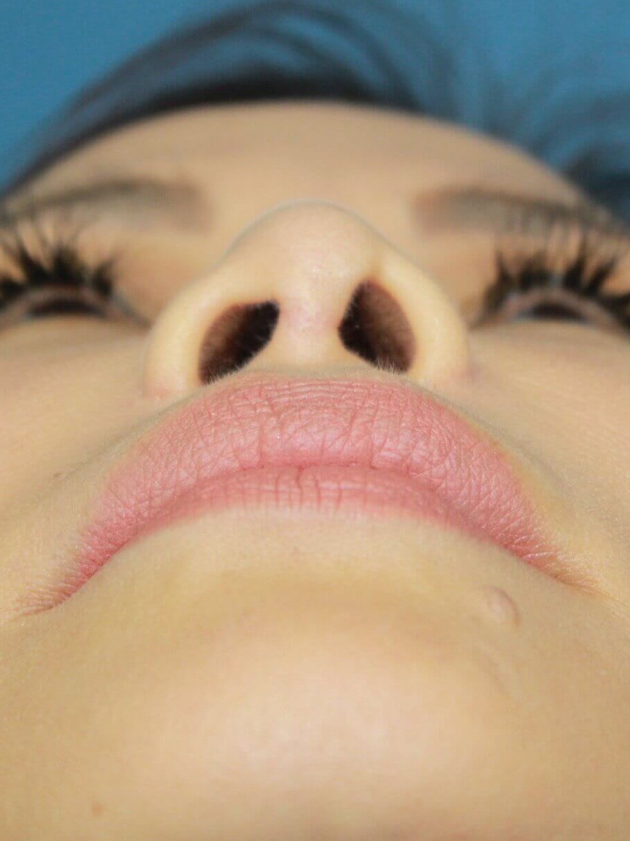 Rhinoplasty before photo