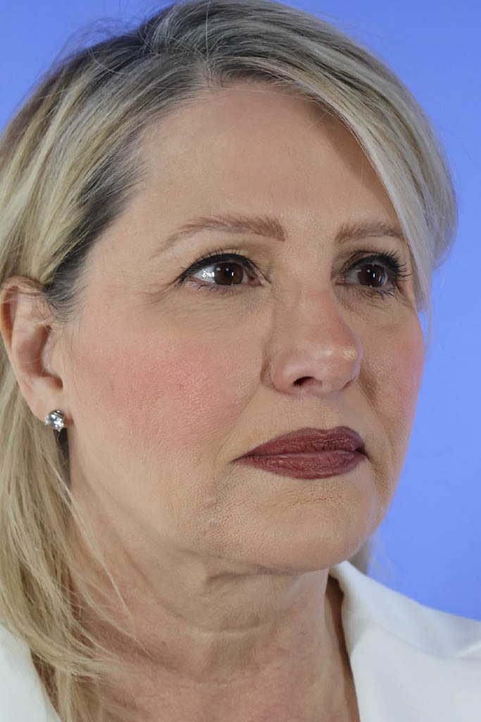 Facelift before photo