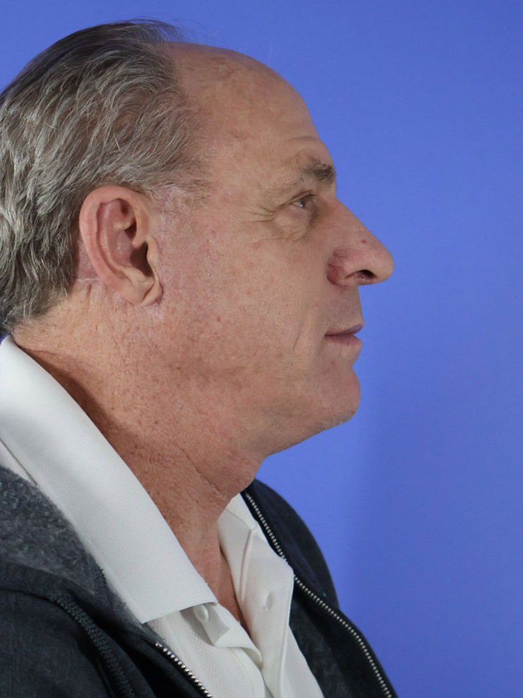 Facelift result at Platinum Plastic Surgery