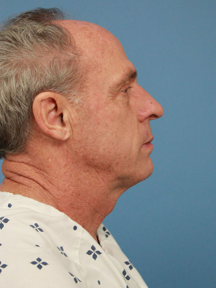 Facelift before photo