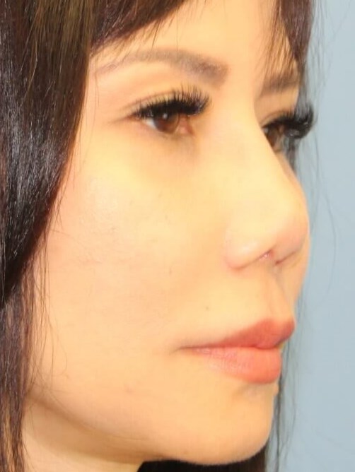 Rhinoplasty result at Platinum Plastic Surgery