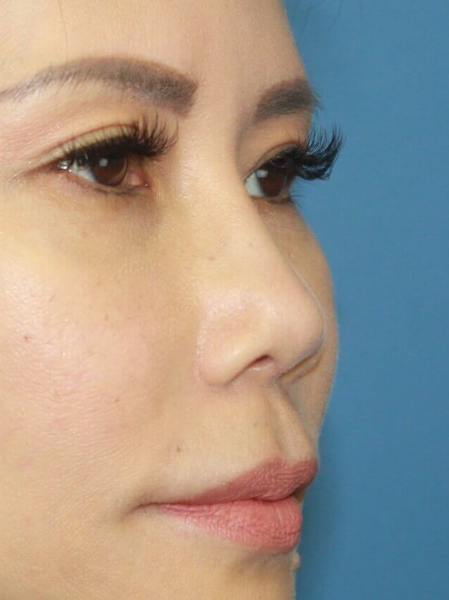 Rhinoplasty before photo